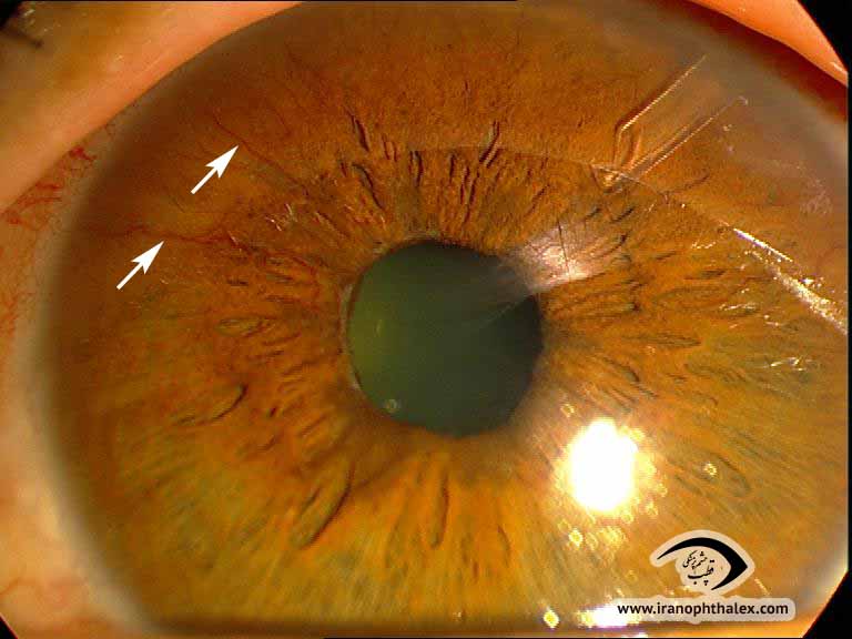 Neovascularization of iris